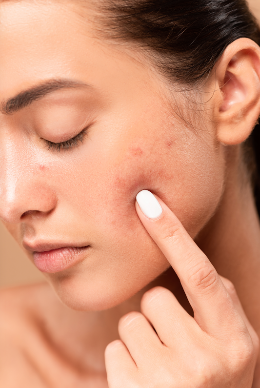 10 Simple Strategies to Eliminate Acne - Huffington Post