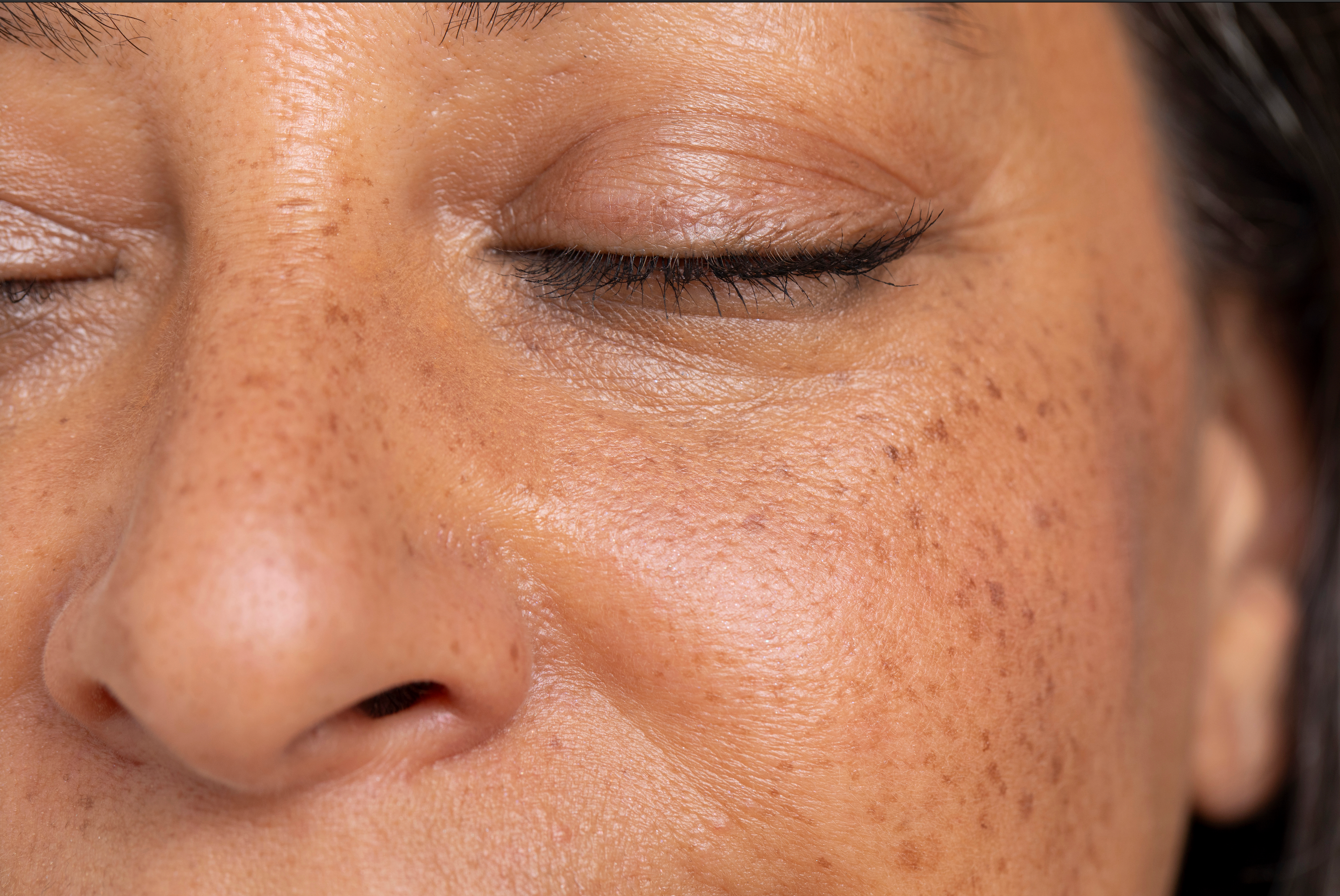 Why Acne & Eczema Could Be Signs of a More Serious Health Issue – Mark Hyman, MD